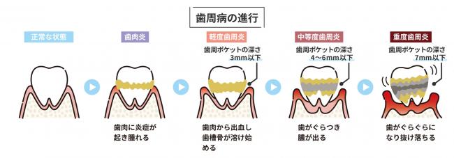 歯周病イラスト